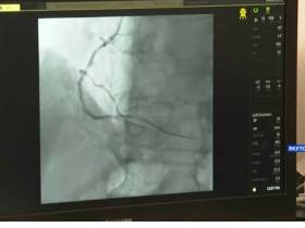 В Якутии впервые провели уникальные операции по эмболизации маточных артерий
