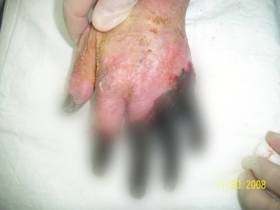 Первыми страдают пальцы, нос и уши: что делать при обморожении и как избежать тяжелых последствий