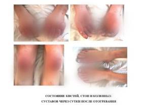 Первыми страдают пальцы, нос и уши: что делать при обморожении и как избежать тяжелых последствий