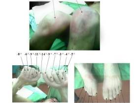 Первыми страдают пальцы, нос и уши: что делать при обморожении и как избежать тяжелых последствий