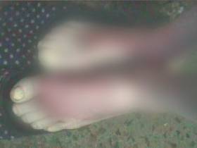 Первыми страдают пальцы, нос и уши: что делать при обморожении и как избежать тяжелых последствий