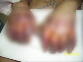 Первыми страдают пальцы, нос и уши: что делать при обморожении и как избежать тяжелых последствий