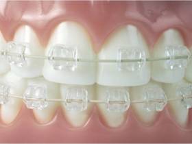 Всё, что нужно знать о брекетах: показания, виды и цены