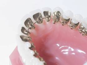 Всё, что нужно знать о брекетах: показания, виды и цены