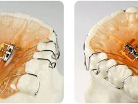 Всё, что нужно знать о брекетах: показания, виды и цены