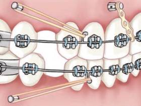 Всё, что нужно знать о брекетах: показания, виды и цены