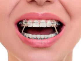 Всё, что нужно знать о брекетах: показания, виды и цены