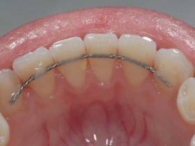 Всё, что нужно знать о брекетах: показания, виды и цены