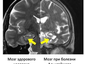 Альцгеймер является причиной деменции в 60–70% случаев: врач рассказал о симптомах заболевания