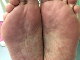 В Якутии наблюдается рост заражений венерическими заболеваниями