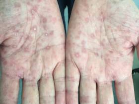 В Якутии наблюдается рост заражений венерическими заболеваниями